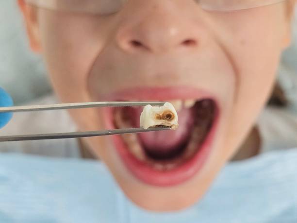 Tooth Infection Emergency Dentist in OH